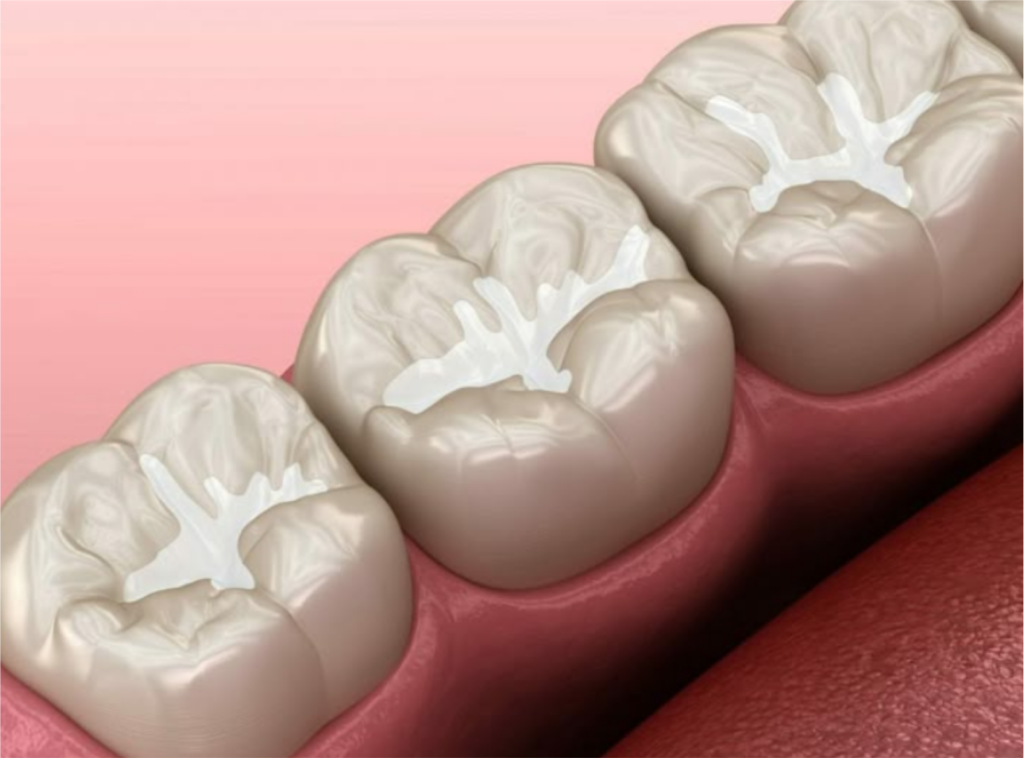 Fissure Sealant atau lapisan pelindung khusus yang diaplikasikan pada permukaan gigi