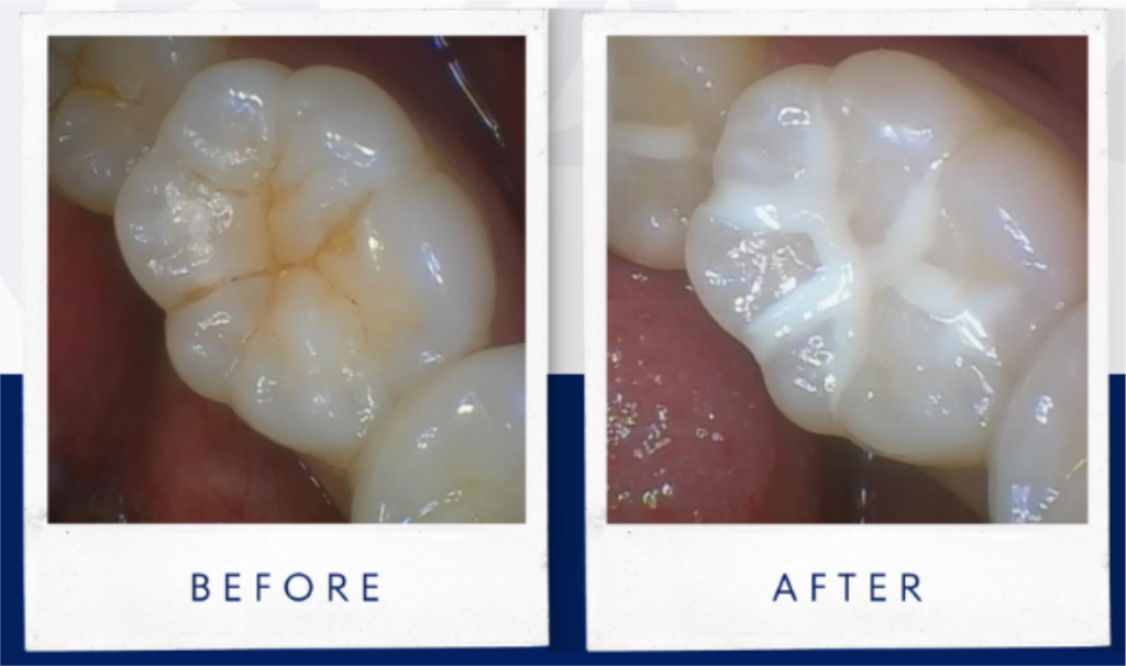 Fissure Sealant - Before & After. foto : Ocean Dental