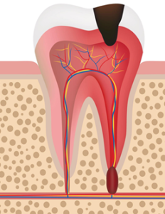 menggambarkan kerusakan gigi tingkat lanjut di mana bakteri telah menembus enamel dan dentin untuk menginfeksi ruang pulpa bagian dalam.